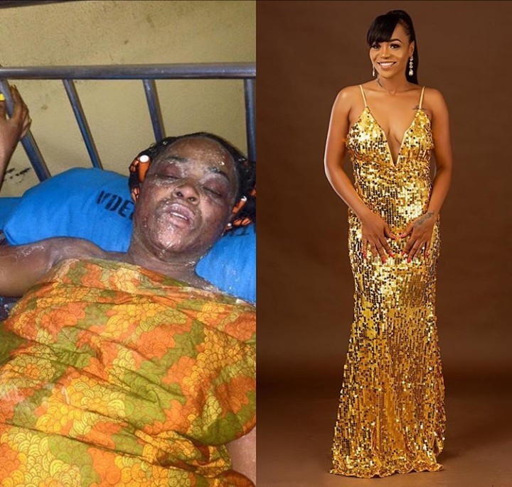 Lady who survived a gas explosion shares photos of her amazing transformation