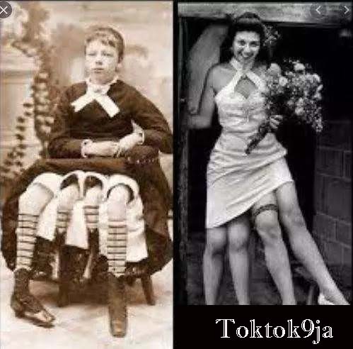 10 Photos That Proves the Lady with Four Legs and Two Genitals Really Existed 
