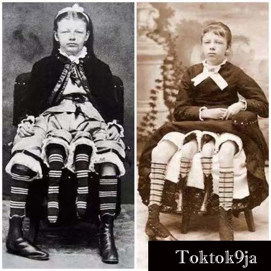 10 Photos That Proves the Lady with Four Legs and Two Genitals Really Existed 