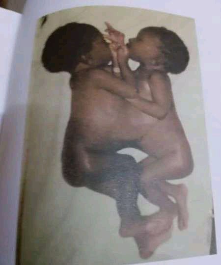 PRAISE GOD!!! Remember The First conjoined Twins Born in Ghana? See How They Look Now