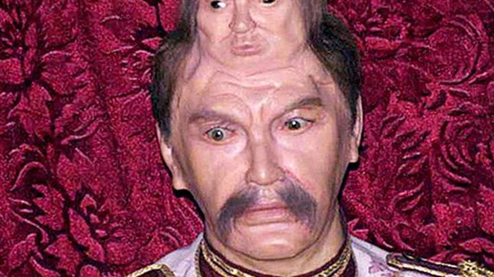 The Captivating Story of  Mexican Man Born With Two Heads - Pascual Pinon