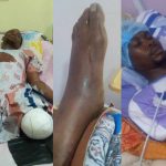 “They Said I Would Lose My Leg”: Nigerian Amputee Recounts Hospital Delays That Cost Him His Leg