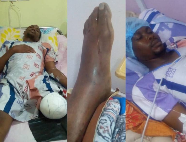 “They Said I Would Lose My Leg”: Nigerian Amputee Recounts Hospital Delays That Cost Him His Leg