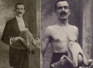 The Man Who Lived a Double Life: The Story of Jean Libbera and His Parasitic Twin