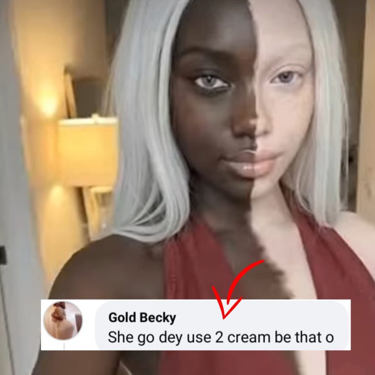 Half-Black, Half-White, and Beautiful: Woman Shares Her Rear Vitiligo Skin Condition, How It Started and How Its’s Going