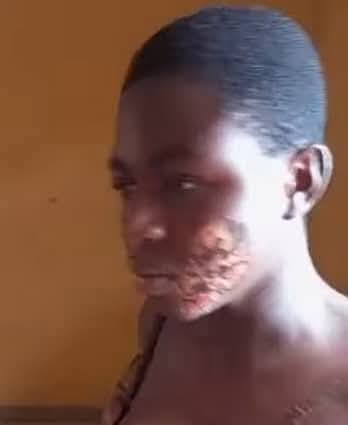 Anambra Police Arrest Woman for Burning Teenage Maid Face, Body with Hot Iron