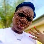 ‘Love Sees No Flaw’ – Lady With Rare Skin Condition Marries Her Heartthrob