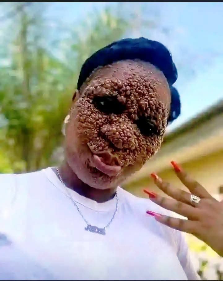 ‘Love Sees No Flaw’ – Lady With Rare Skin Condition Marries Her Heartthrob