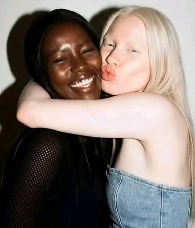 Meet the Twins Who Look Nothing Alike: One White, One Black, Both Born to the Same Parents