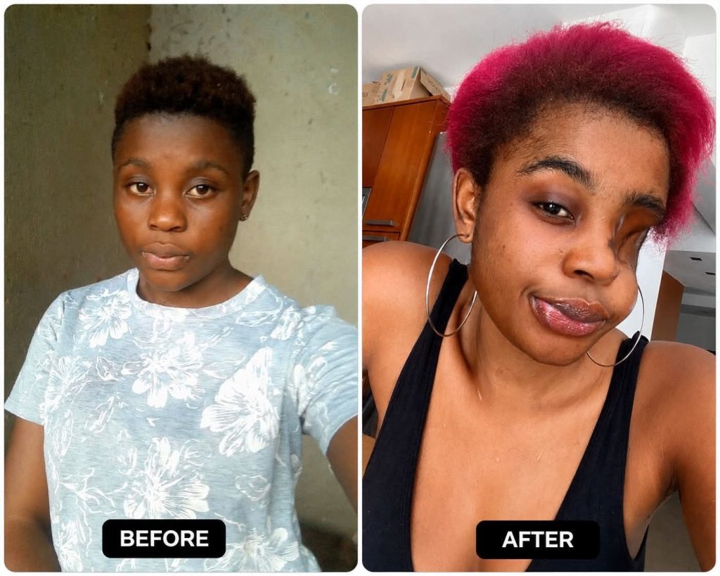 “I’m Not Seeking Sympathy”: Woman Who Lost an Eye Shares Powerful Message