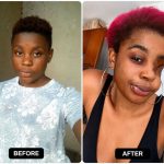“I’m Not Seeking Sympathy”: Woman Who Lost an Eye Shares Powerful Message