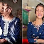 Afsheen Gul Could Not Hold Her Head Upright for 12 Years – Then a Delhi Surgeon Offered Her a Second Chance