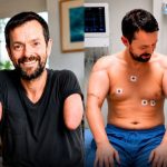 The Man Who Received the World’s First Double Arm Transplant